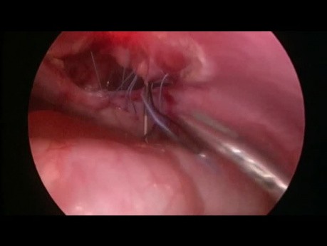 Reparación laparoscópica de la hernia de Morgagni retroesternal