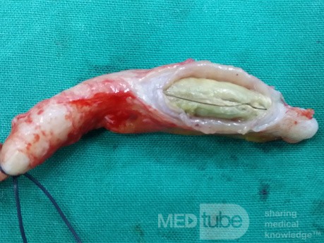 Apendicitis obstructiva aguda