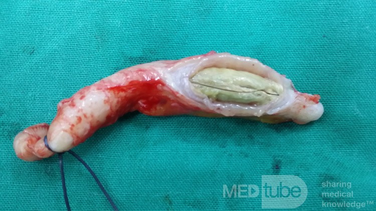 Apendicitis obstructiva aguda