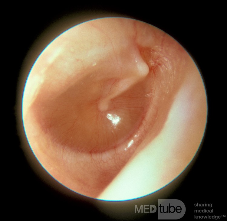 Otitis media mucoide