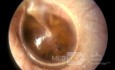 Otitis media serosa en adultos