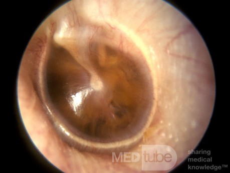 Otitis media serosa en adultos