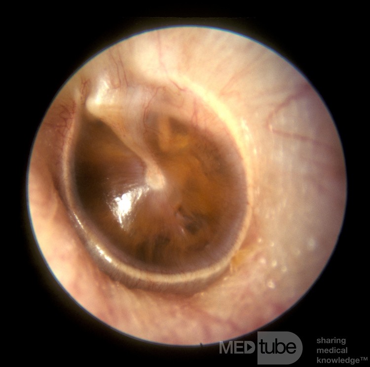 Otitis media serosa en adultos