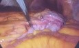 Hemicolectomia Derecha Ampliada En Cancer Colon Transverso Por Laparoscopia