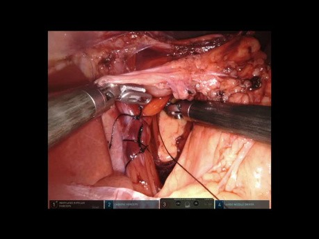 Cirugía robótica de la hernia de hiato 