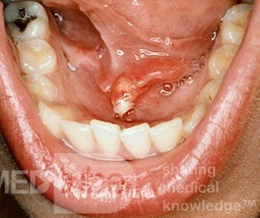 Piedra del conducto submandibular