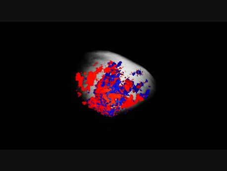 Coriocarcinoma (Doppler)