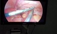 Apendicitis