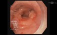 Cierre de fístula colorrectal