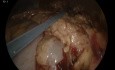 Apendicitis perforada gangrenosa aguda con peritonitis generalizada