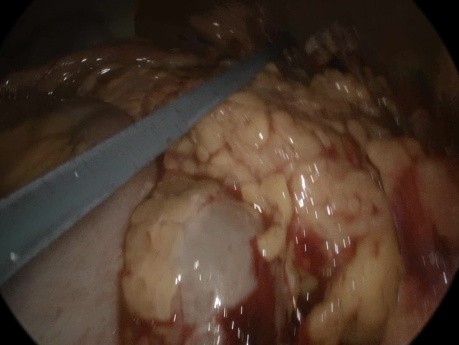 Apendicitis perforada gangrenosa aguda con peritonitis generalizada