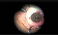 Un día con cirugía plástica de iris. Razones postraumáticas, posquirúrgicas, posinflamatorias y congénitas de esta reparación