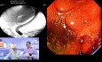 Más allá del duodenoscopio: Optimización de los resultados con colangioscopia peroral directa en casos biliares complejos
