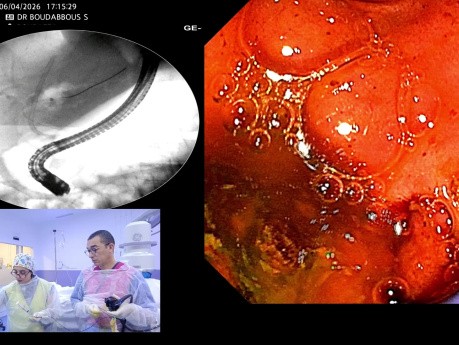 Más allá del duodenoscopio: Optimización de los resultados con colangioscopia peroral directa en casos biliares complejos