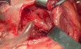 Anastomosis gastroenteral realizada con grapadora circular