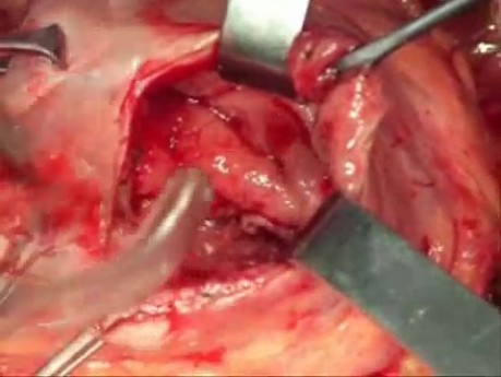 Anastomosis gastroenteral realizada con grapadora circular