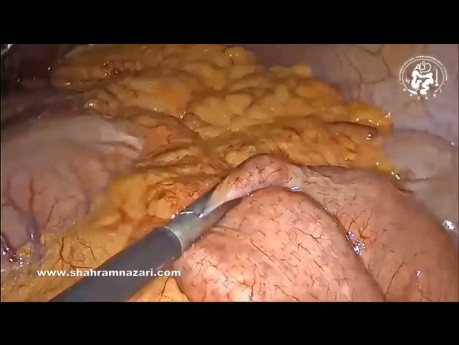 Un bypass gástrico de anastomosis como rehacer la cirugía después de una gastrectomía en manga fallida