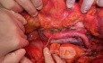 Arteria renal derecha precava durante linfadenectomía por cáncer de endometrio