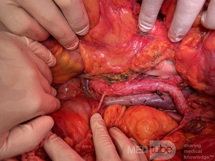 Arteria renal derecha precava durante linfadenectomía por cáncer de endometrio
