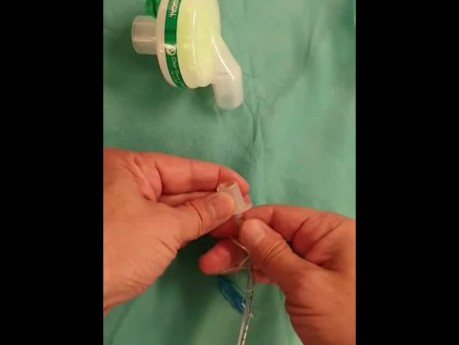 Cirugía en tiempos de COVID-19: conexión del filtro de desuflación después de una laparoscopia