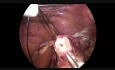 Enucleación laparoscópica de leiomioma esofágico distal; funduplicatura de Nissen