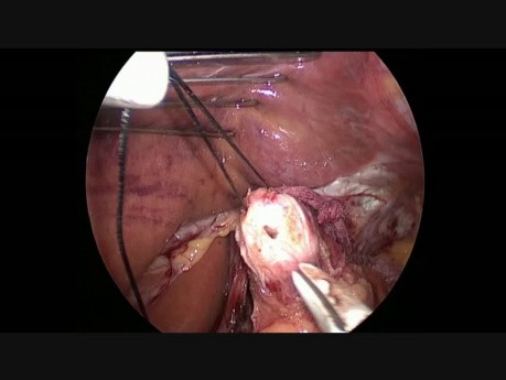 Enucleación laparoscópica de leiomioma esofágico distal; funduplicatura de Nissen