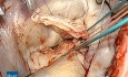 Reparación de la válvula mitral de la enfermedad de Barlow compleja