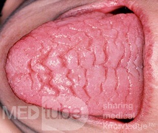 Lengua fisurada