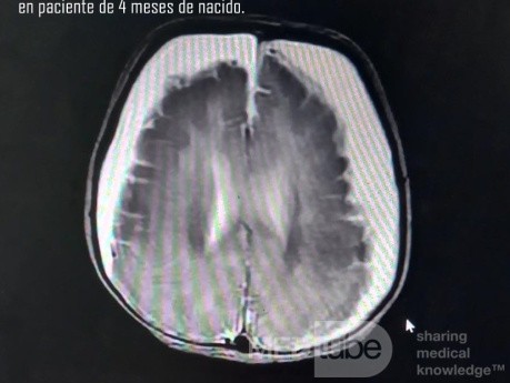Cirugía de burgencia con técnica de Burr Hole, bilateral de forma exitosa