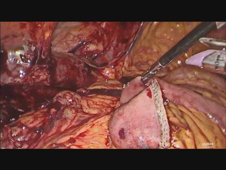 Hepatoyeyunostomía laparoscópica por una lesión iatrogénica del conducto biliar