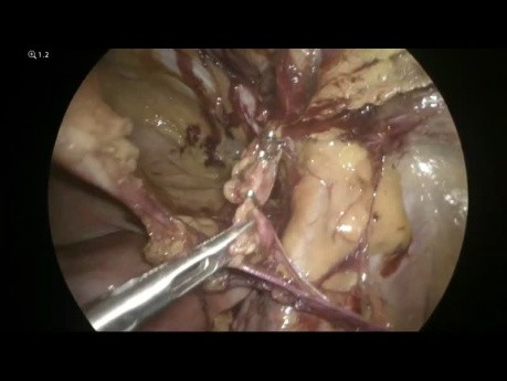 Hernia femoral laparoscópica