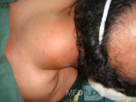 Lipoma en la cara posterior del cuello