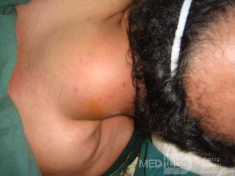 Lipoma en la cara posterior del cuello