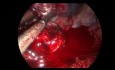 Bilobectomía intrapericárdica de doble manga del lado derecho con VATS uniportal