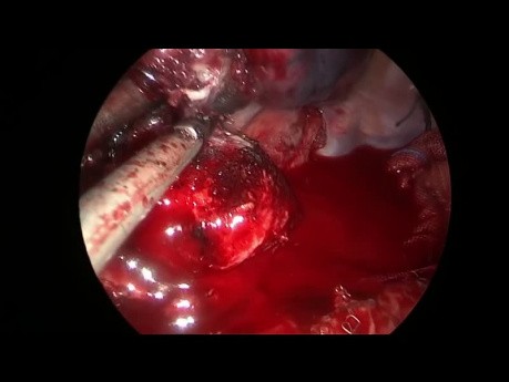 Bilobectomía intrapericárdica de doble manga del lado derecho con VATS uniportal