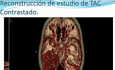 Hemangioblastoma Supratentorial