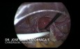 Utilidad de la laparoscopia en la colocación de un catéter de Tenckhoff