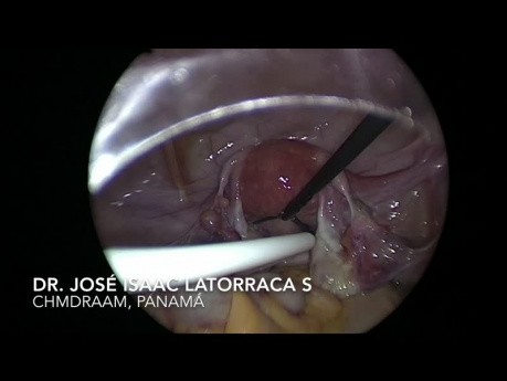 Utilidad de la laparoscopia en la colocación de un catéter de Tenckhoff