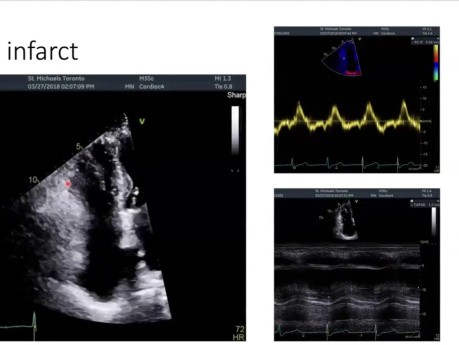 Evaluación ecocardiográfica de las complicaciones mecánicas debidas al infarto de miocardio