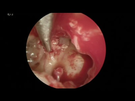 Cirugía del colesteatoma (endoscópica y microscópica)