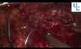 Nefrectomía parcial con pinzamiento arterial selectivo en un riñón único
