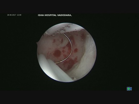 Corección histeroscópica de istmocele