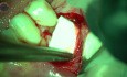 Tratamiento de la enfermedad periodontal crónica con tecnología láser