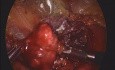 Metástasis de carcinoma solitario de células renales: 2,5 años después de la nefrectomía derecha
