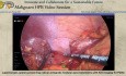 Pancreatectomía modular anterógrada radical laparoscópica con preservación del bazo guiada por imagen con verde de indocianina para el adenocarcinoma ductal pancreático