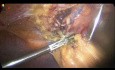 Cirugía previa del abdomen superior durante la colecistectomía laparoscópica