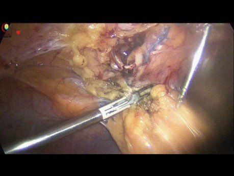 Cirugía previa del abdomen superior durante la colecistectomía laparoscópica