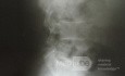 Metástasis lumbares de cistoadenocarcinoma de páncreas