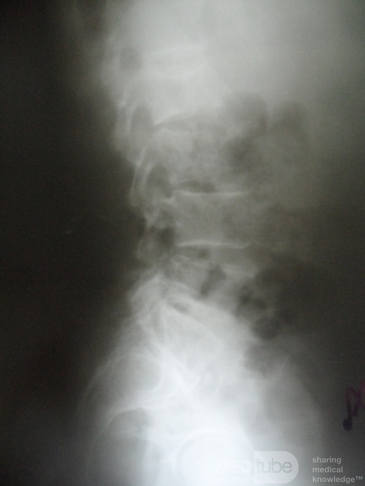 Metástasis lumbares de cistoadenocarcinoma de páncreas