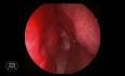 Resección endoscópica del adenoma hipofisario